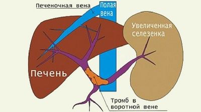 Тромбоз портальной вены не такое уж и редкое явление.