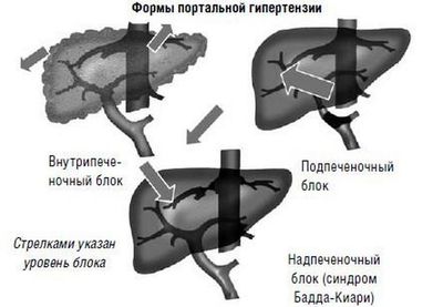 Портальная гипертензия может возникнуть, например, при циррозе.