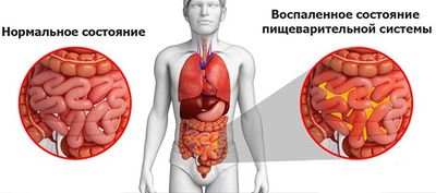 Перитонит