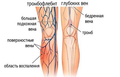Как лечить посттромбофлебитический синдром нижних конечностей