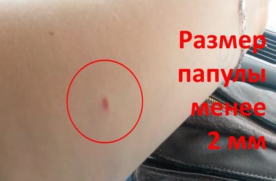 Размер папулы менее 2 мм