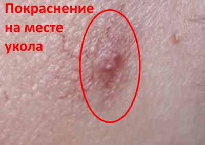 Покраснение на месте укола