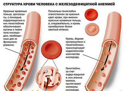 Железосодержащие продукты при анемии