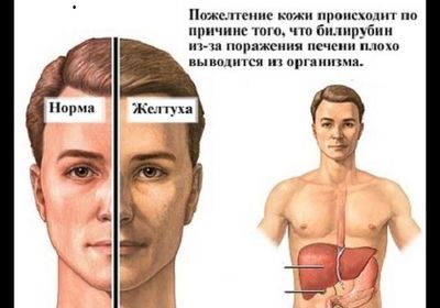 Симптомы желтухи
