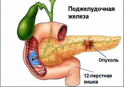 локализация опухоли ПЖ