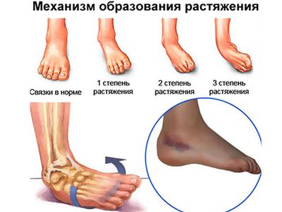 Растяжение связок