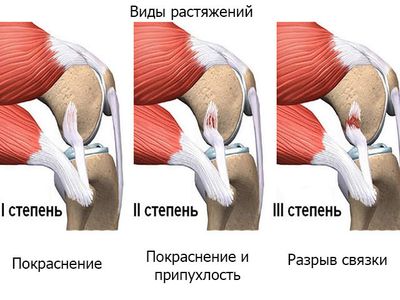 Виды растяжения связок