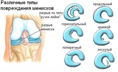 Классификация повреждений коленных менисков