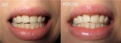 до и после насыщения эмали минералами