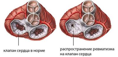 Ревматизм очагового типа