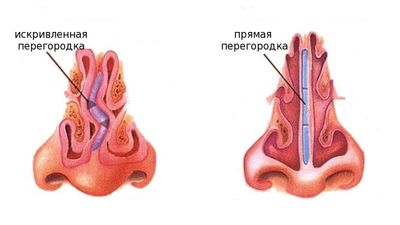 Виды септопластики, показания и противопоказания к проведению операции, период реабилитации