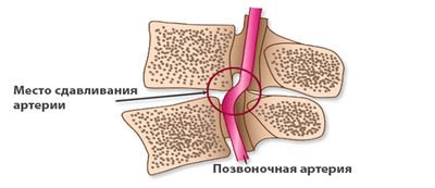 Симптомы и методы лечения одышки при остеохондрозе