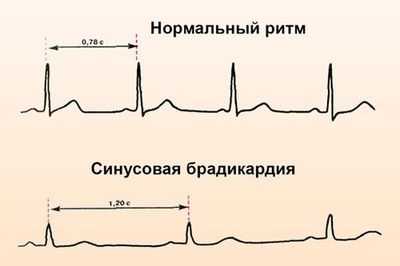 экг сердца