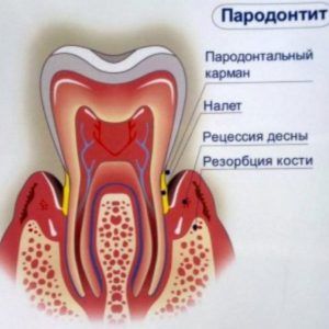 Пародонтит