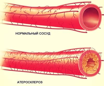 Атеросклероз сосудов