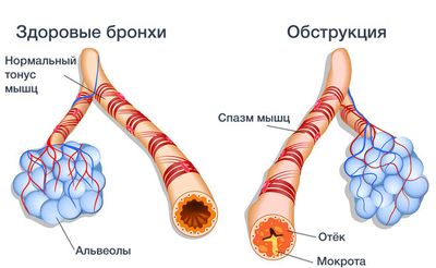 Признаки обструкции