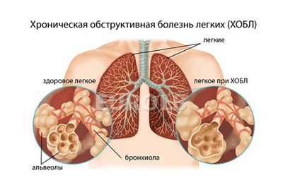 Хроническая обструктивная болезнь легких