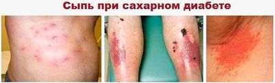 сыпь при сахарном диабете