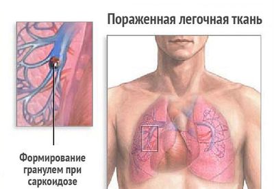 Саркоидоз легких