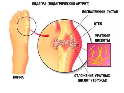 Подагра