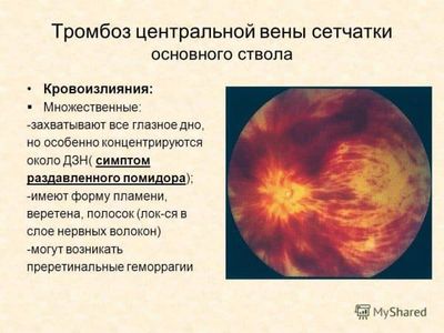 Тромб в глазу - лечение тромбоза центральной вены сетчатки