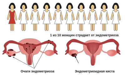 удаление эндометриоза