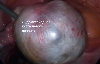 удаление эндометриоза