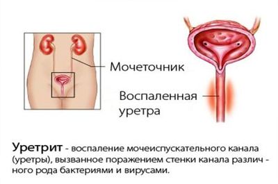 Современное лечение уретрита у женщин и его симптомы