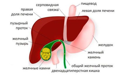 камни в желчном
