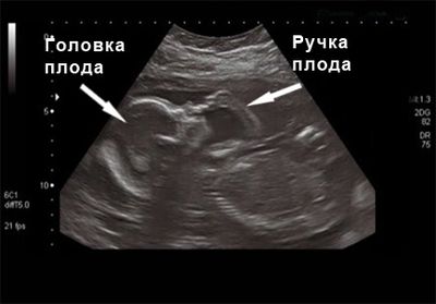 Процедура УЗИ во втором триместре