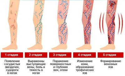 стадии варикоза ног