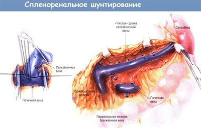 Спленоренальное шунтирование