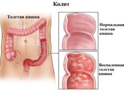 Симптомы воспаления толстого кишечника и лечение
