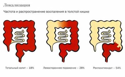 тотальный колит