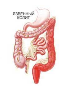 язвенный колит