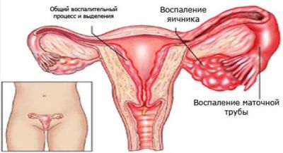 Симптомы, лечение и последствия воспаления яичников у женщин