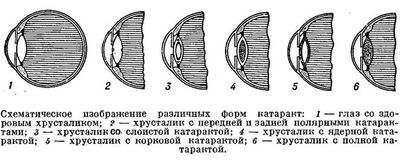 Причины, симптомы и лечение врождённой катаракты у детей
