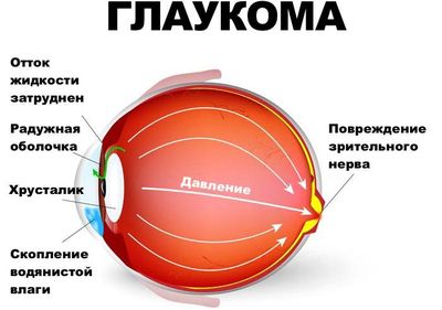 Глаукома