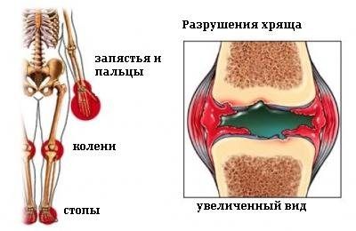 артрит ювенильный