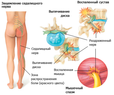 Что делать при защемлении нерва в ноге